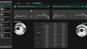 Optical Coherence Tomography