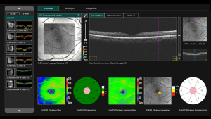 Epithelial thickness mapping