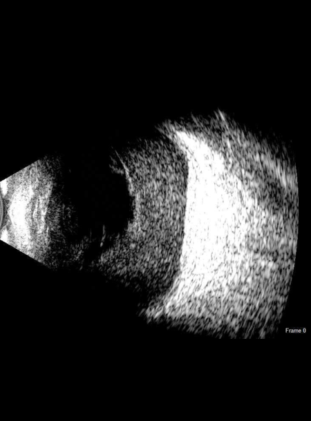 Retinal Detachments